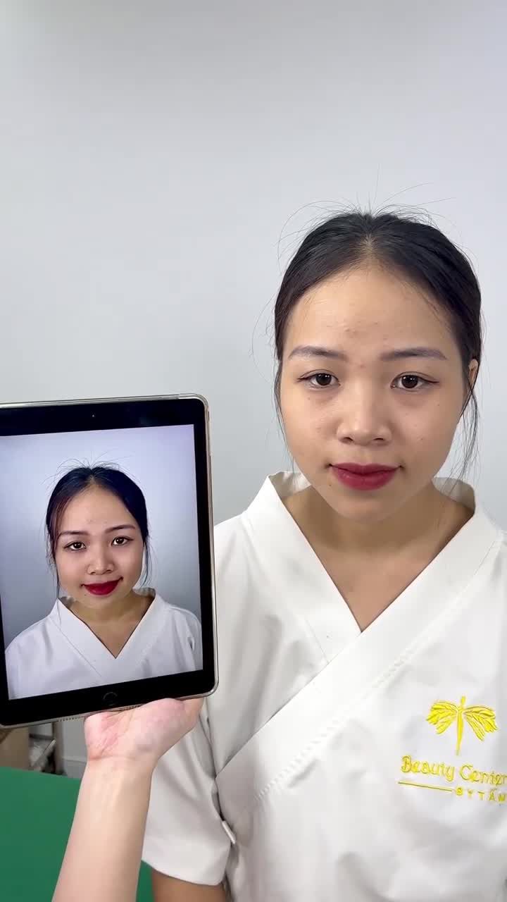 Ca thon gọn Vline Perfect quay lại tái khám tại TMV Tấm